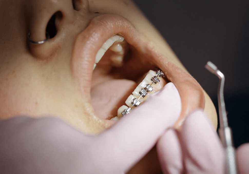 history of orthodontics