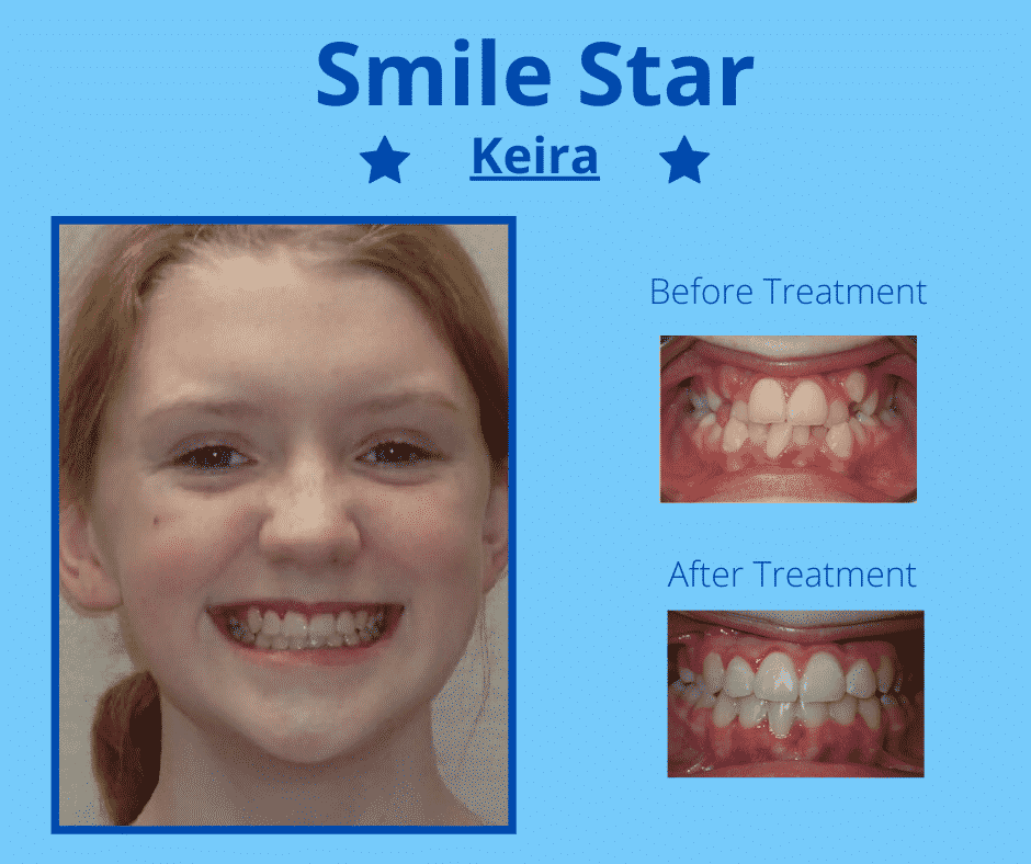 Keira: Crowded Teeth and a Crossbite