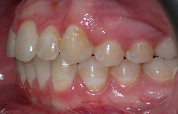 left buccal after completing Invisalign® treatment 9 Months Early