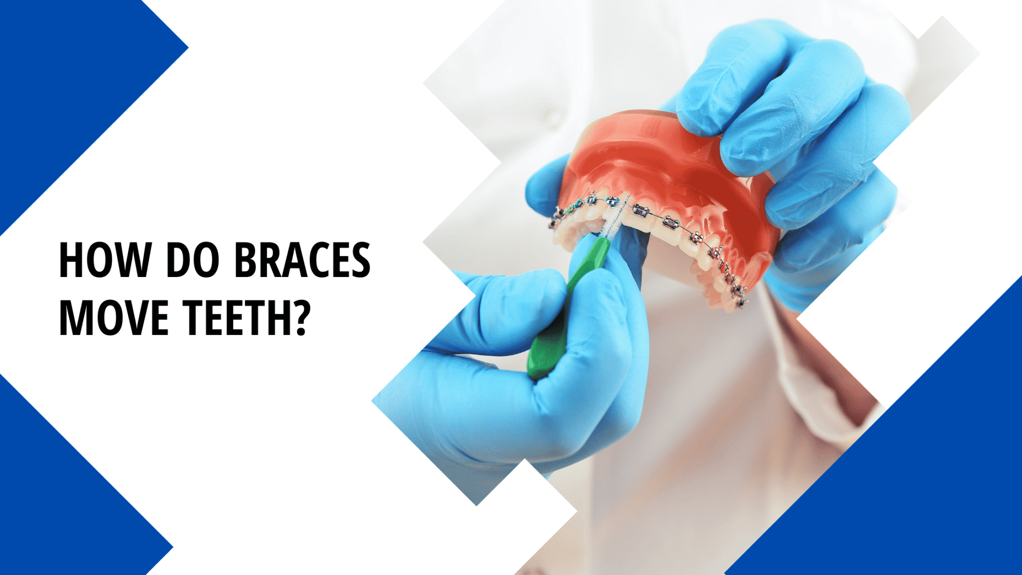 How braces move teeth to straighten them